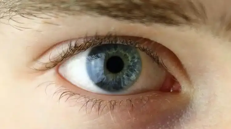 Œil astigmate avec déformation de la cornée provoquant une vision floue
